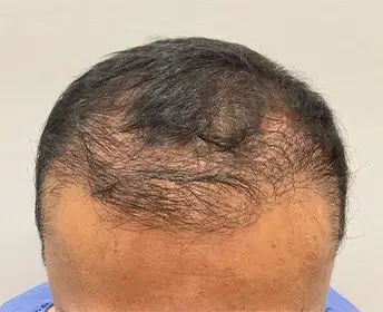 before-hair-restoration-capilar-hair-center