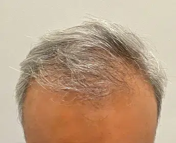 before-process-hair-restoration-capilar-hair-center