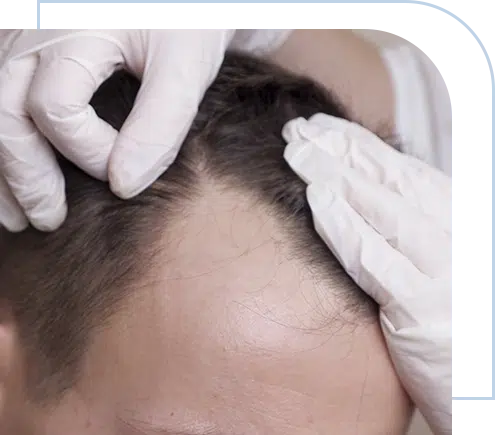primary-alopecia-the-patient-has-some-disease-that-causes-the-appearance-of-lesions-on-the-scalp-capilar-hair-center-tijuana