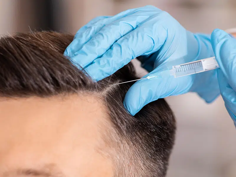 how-much-is-a-hair-transplant-in-tijuana-treatments-prices-capilar-hair-center-tijuana