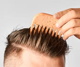 androgenic-alopecia-often-referred-to-as-man-pattern-baldness-is-a-common-form-of-hair-loss-that-can-affect-both-men-and-women-capilar-hair-center-tijuana