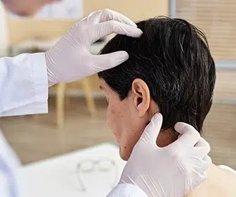 dandruff-is-a-common-scalp-condition-known-for-the-shedding-of-dead-skin-cells-in-the-shape-of-white-flakes-capilar-hair-center-tijuana