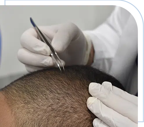 there-are-hair-restoration-techniques-such-as-fut-in-capilar-hair-center-tijuana