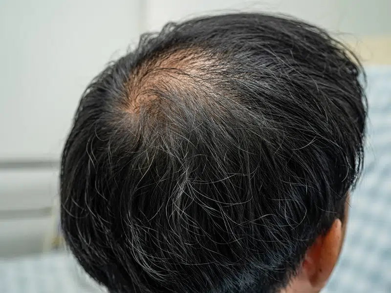 what-causes-androgenic-alopecia-5-reasons-and-how-to-fix-it-capilar-hair-center-tijuana