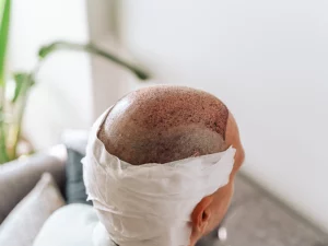 all-you-need-to-know-dhi-hair-transplant-recovery-time