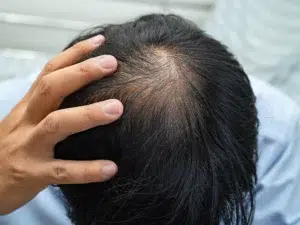 fue-transplant-best-clinic-for-hair-loss-treatment-tijuana
