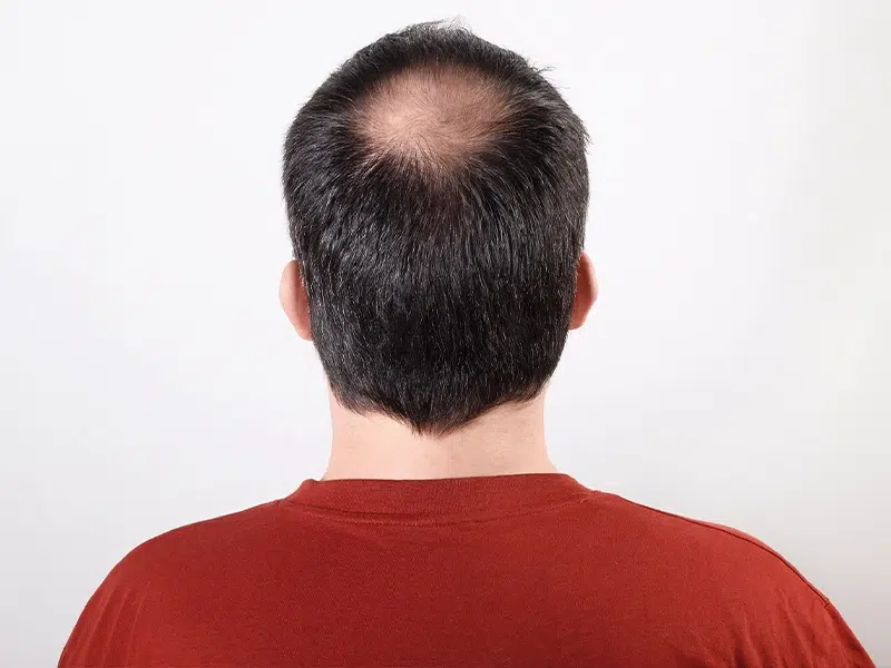 what-is-androgenetic-alopecia-bald-on-top-but-hair-on-sides