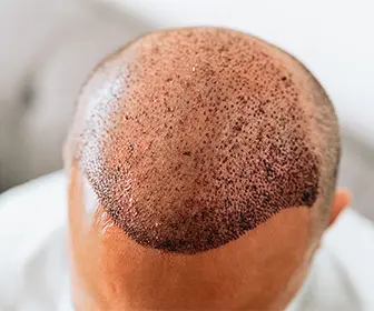 fue-transplant-guide-what-does-a-lost-hair-graft-look-like