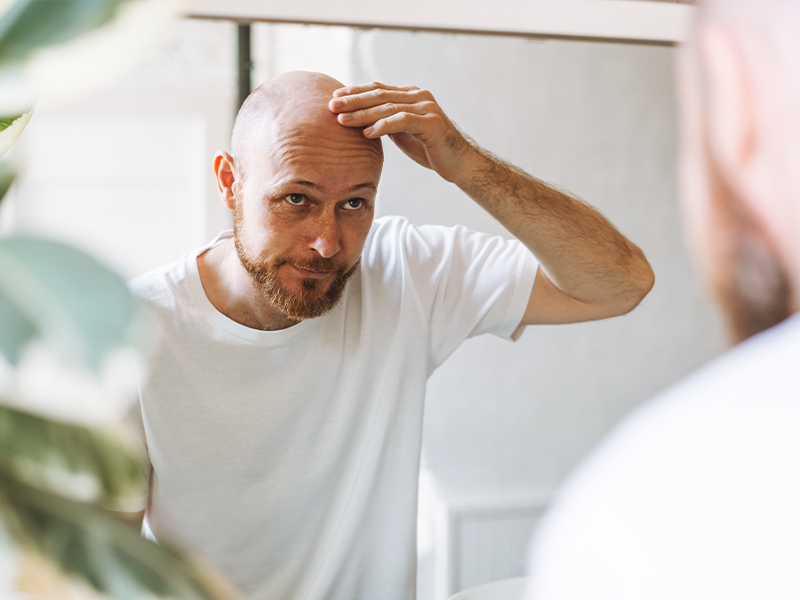 The Norwood Hamilton Scale The Seven Male Hair Loss Stages