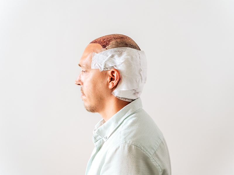 What Does The Hair Transplant Recovery Timeline Look Like