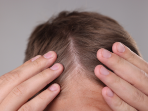 Chc tijuana faq how long does a fue hair transplant last