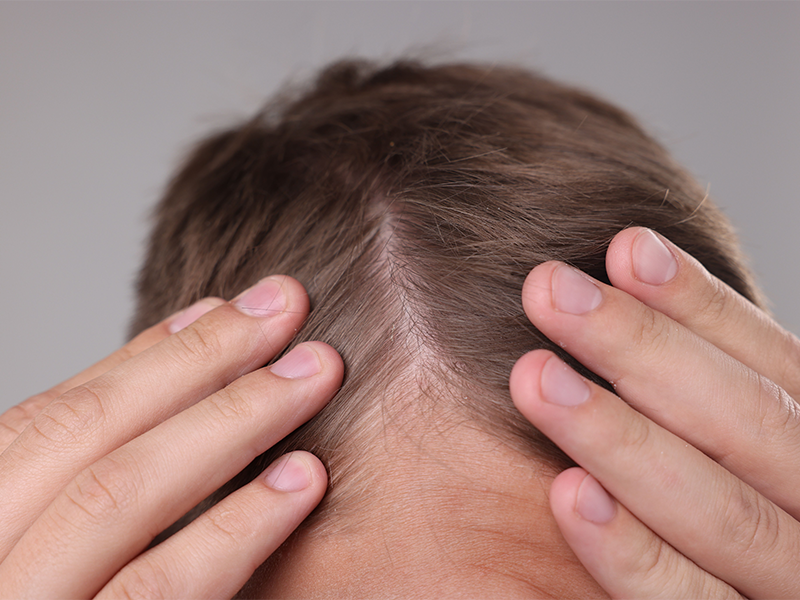 Chc tijuana faq how long does a fue hair transplant last